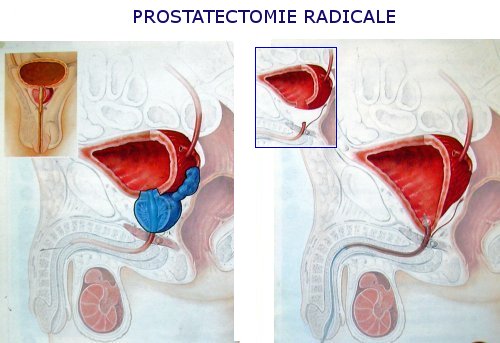 prostatectomie totale et impuissance