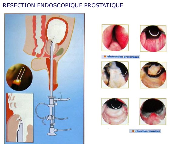 résection endoscopique prostate hypertrophie de la prostate opération au laser